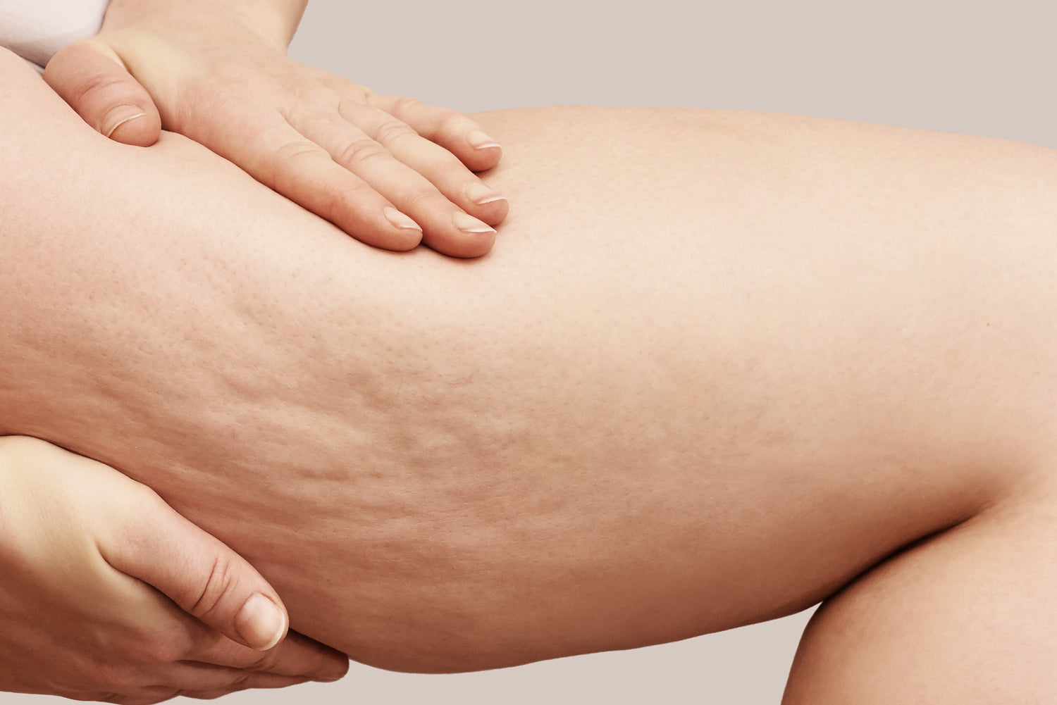 Cellulite